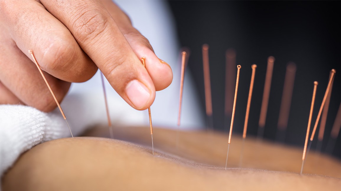Acupuntura